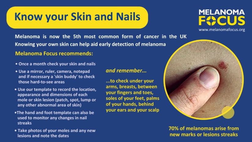 Melanoma Focus